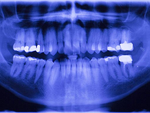 dentist showing x-ray of teeth to patient